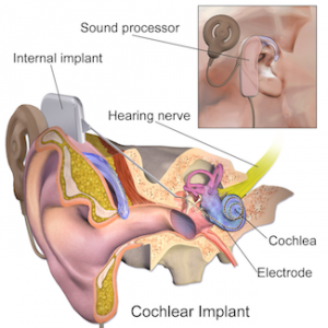 Cross Section of a Cochlear Implant