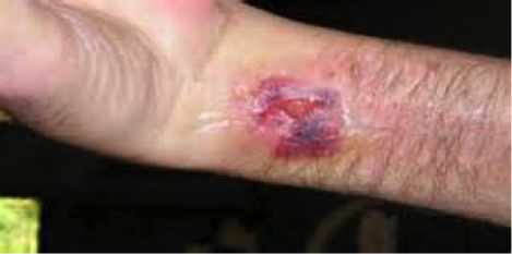 Bacterial Infection--Encompass HealthCare & Wound Medicine, West Bloomfield, Michigan