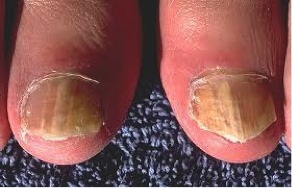 Example of a fungal infection, Encompass HealthCare & Wound Medicine, West Bloomfield, Michigan