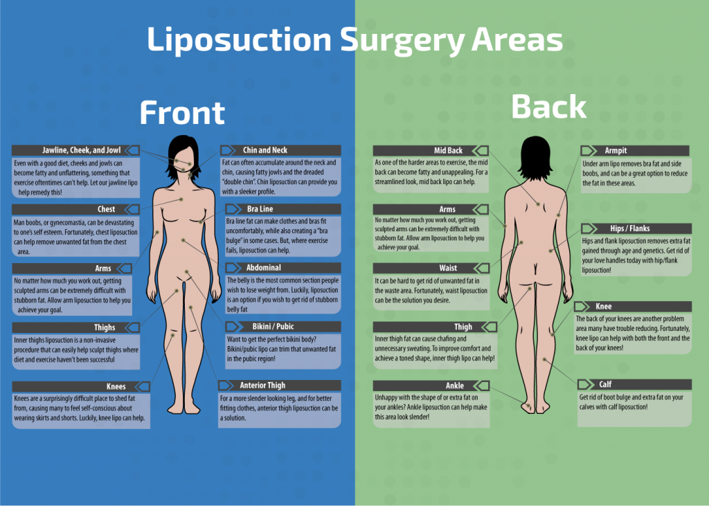 Infographic - Popular Areas for Liposuction