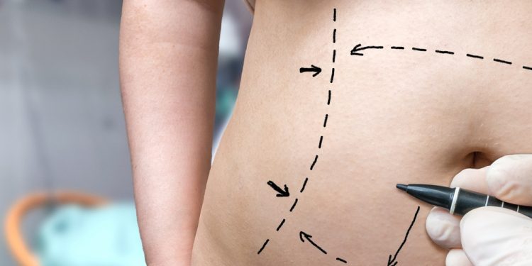 Are Liposuction Results Permanent? Dr. Heather Rocheford Answers