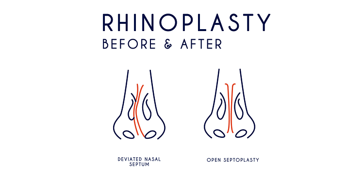 Functional Rhinoplasty Featured Image