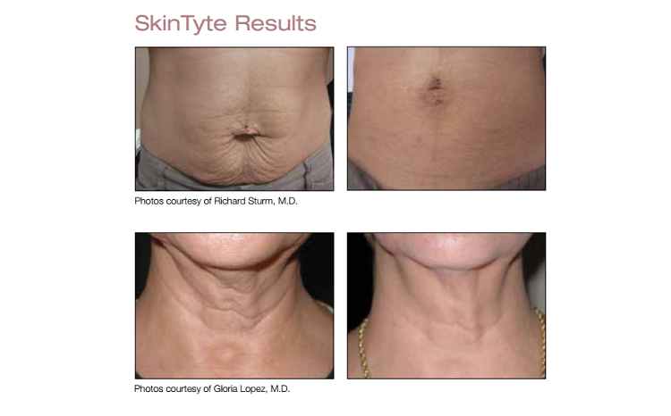 Before & After: SkinTyte Skin Tightening