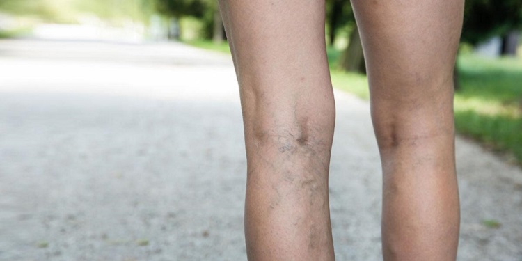 Back of a Female's Legs with Spider Veins