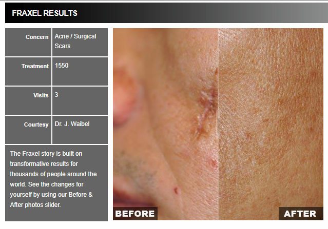 Fraxel Before & After Photo of Acne Scars