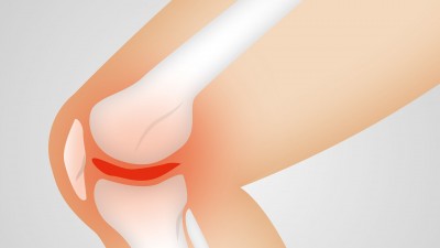 Artificial Hips, Arthritis (General), Knee Problems, Surgery (General)
