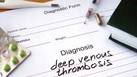 Know Your Risk for Deep Vein Thrombosis