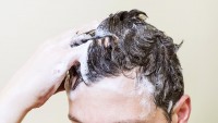 Dandruff, Hair And Scalp Problems