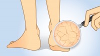 Foot Problems (General), Psoriasis