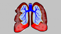 Respiratory Problems (General)